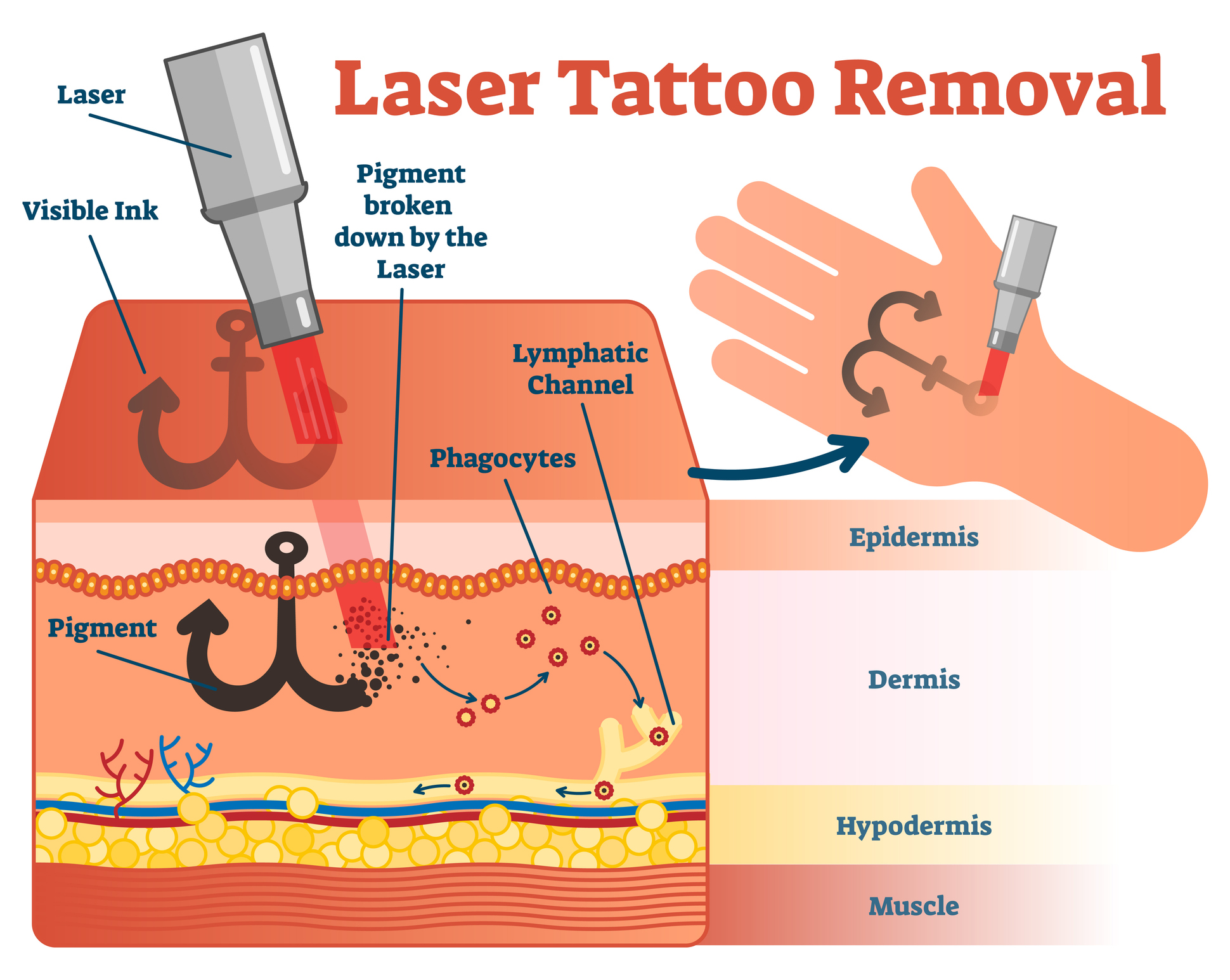 LASER